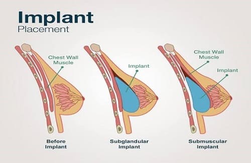 Kaavio rintaimplanttien istuttamisesta lihaksen alle ja päälle