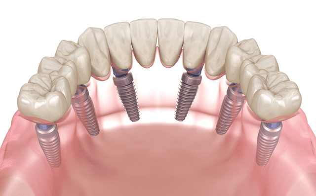 Schéma d'implant dentaire all-on-6