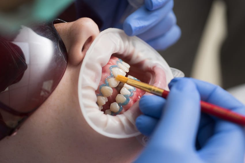 Blanchiment des dents