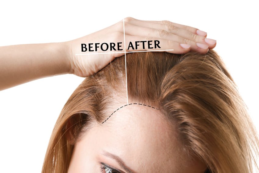 Simulation greffe de cheveux pour femme