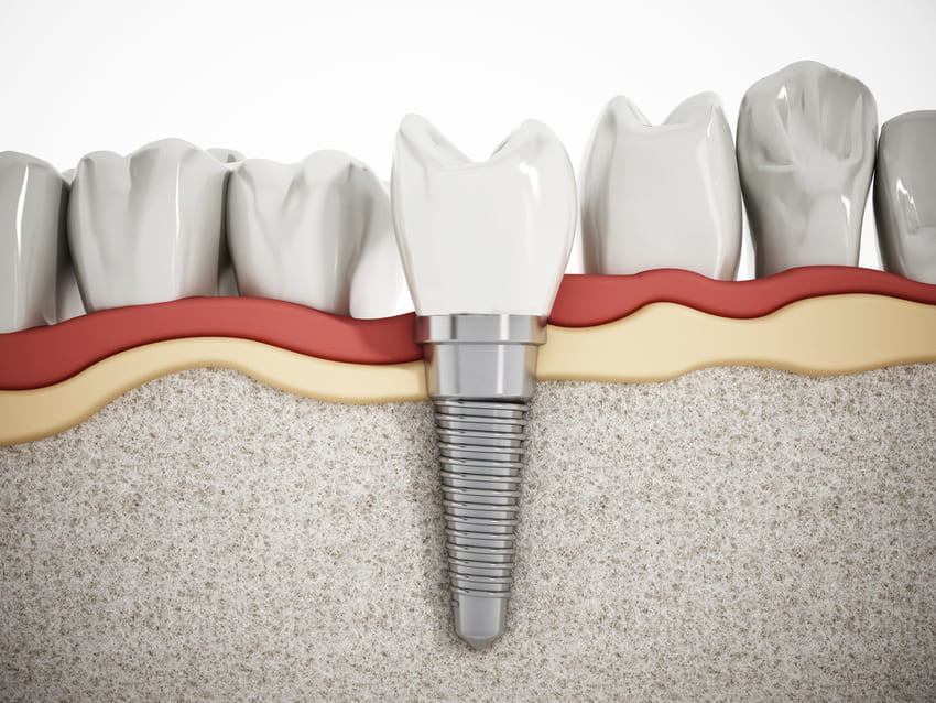 Schéma d'un implant dentaire