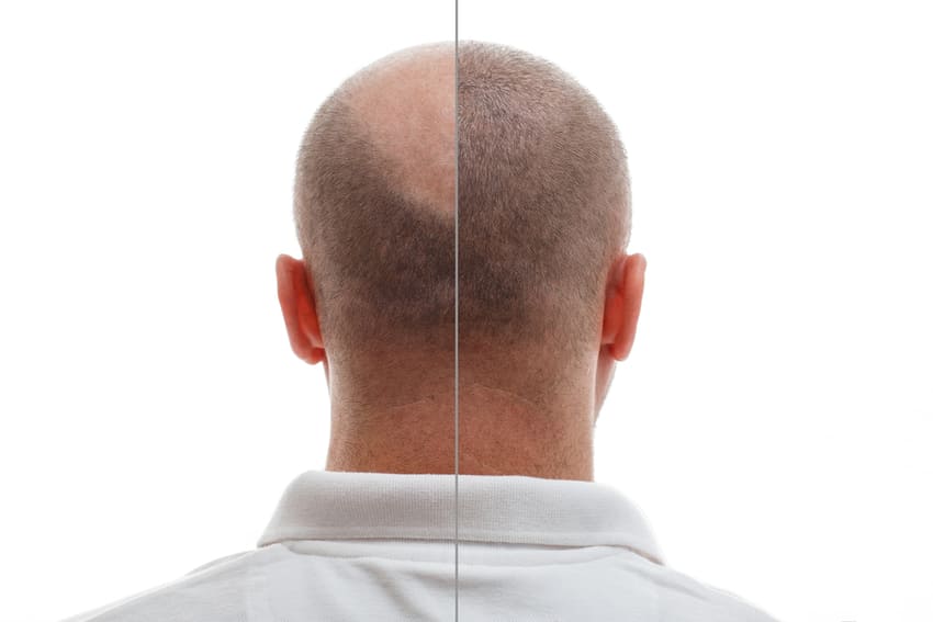 Simulation photo avant et apres la greffe de cheveux