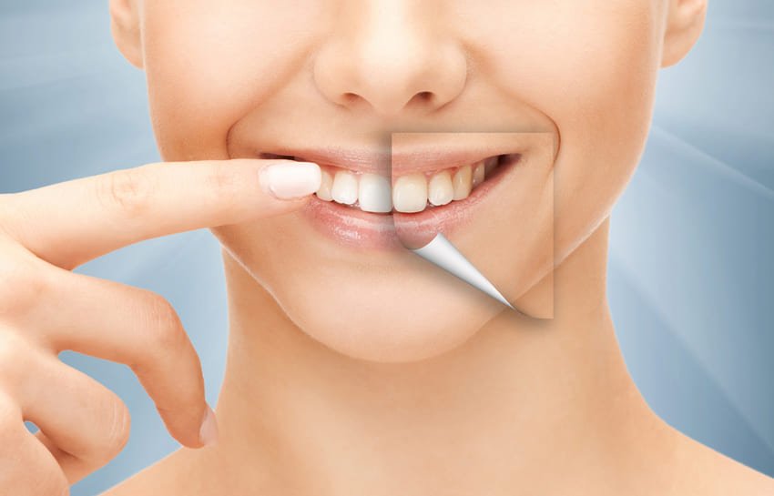 Illustration d'une dentition avant et après un hollywood smile