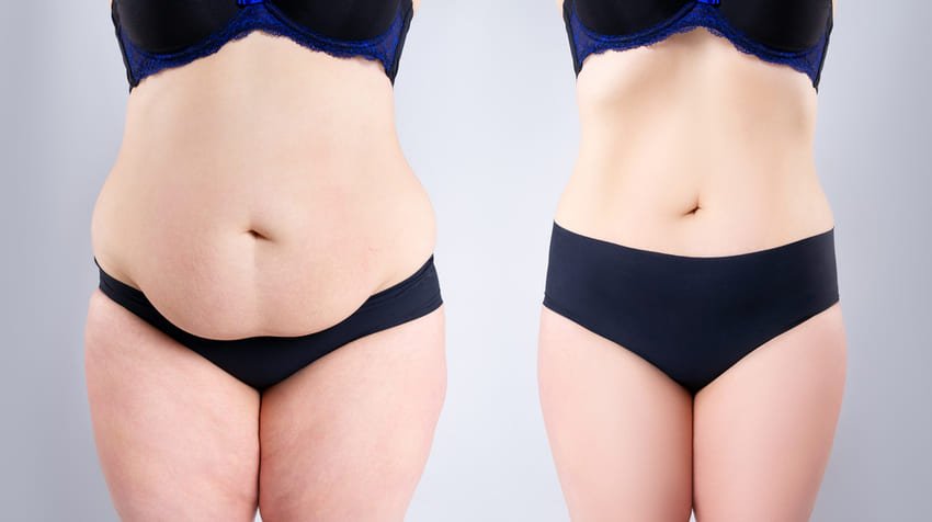 Simulation avant et après d'une abdominoplastie d'une femme