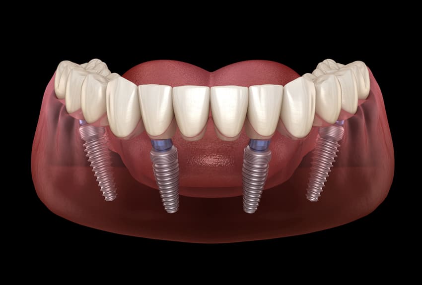 Image de synthèse d'une mâchoire inférieure avec un All-on-4