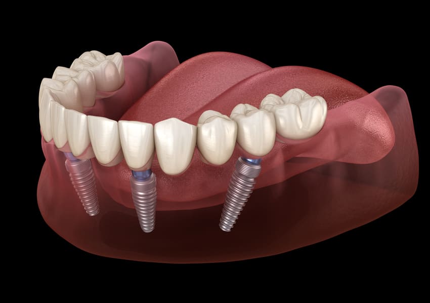 Image de synthèse d'une mâchoire inférieure avec un All-on-4