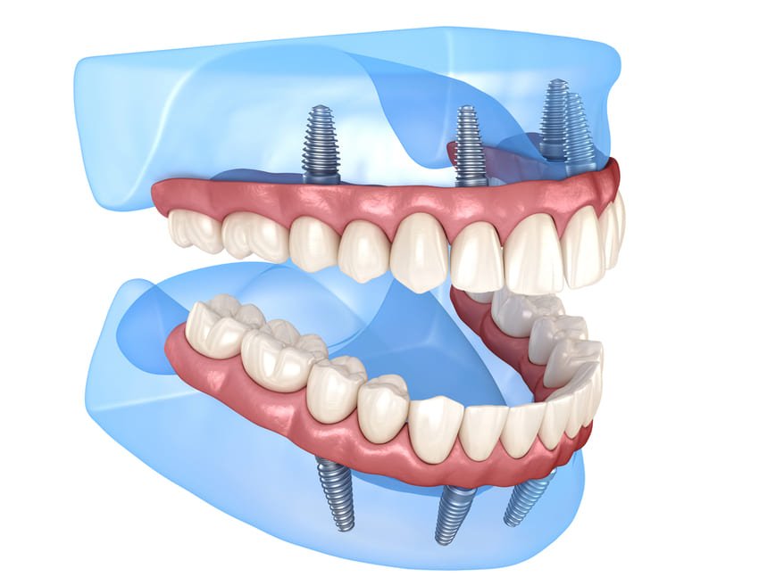 Image de synthèse d'une mâchoire inférieure et supérieure avec un All-on-4