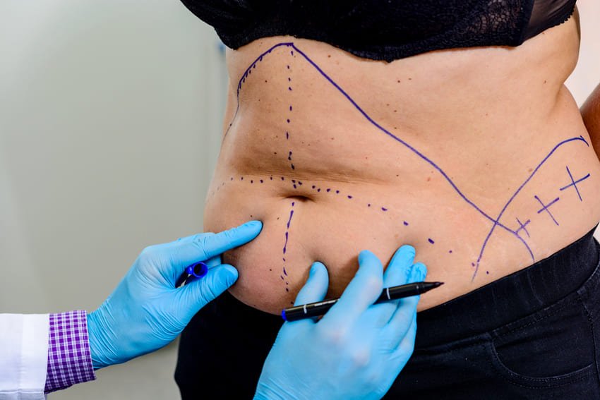 Tracé d'un chirurgien sur un ventre pour une abdominoplastie