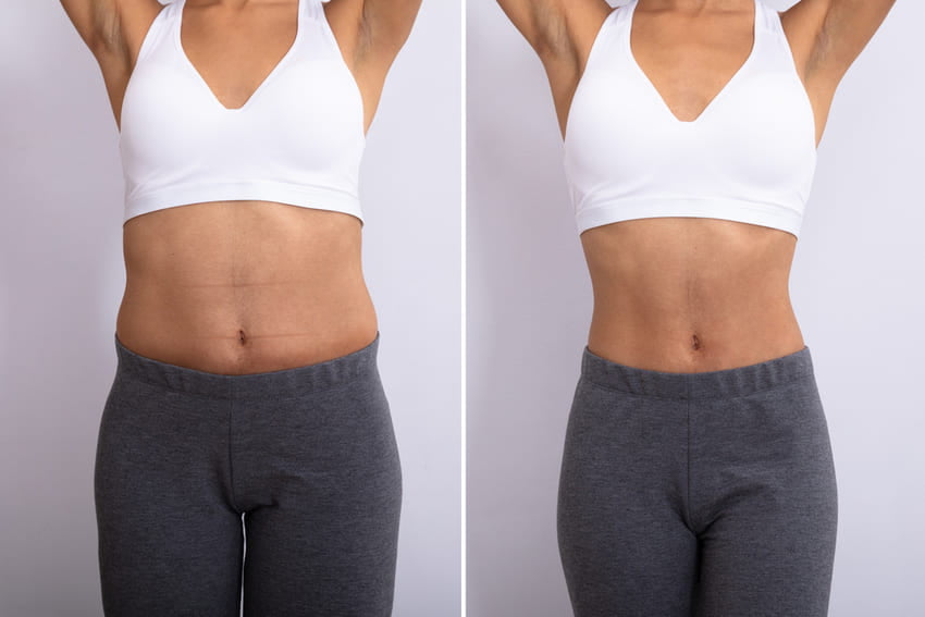Résultat avant et après d'une abdominoplastie d'une femme noire