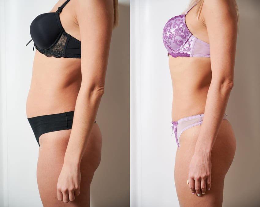 Photo avant et après d'une abdominoplastie d'une femme