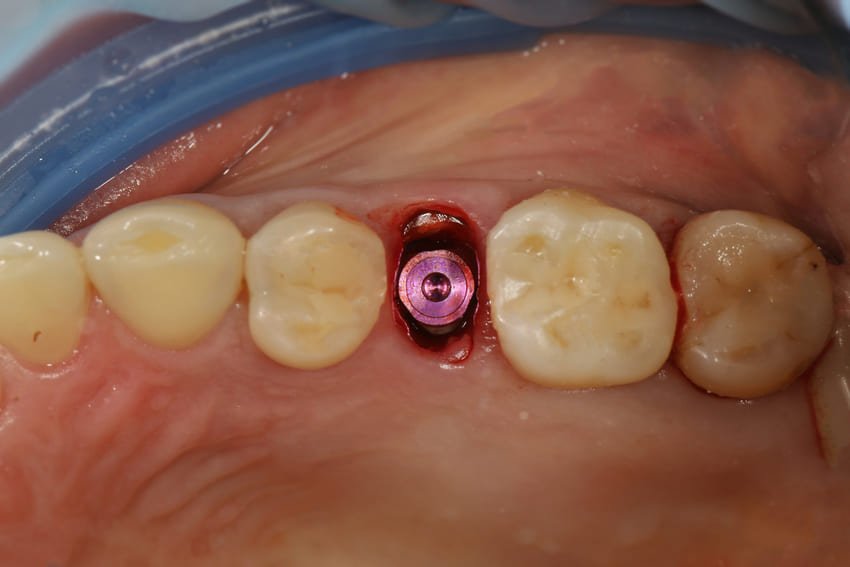 Pose d'un implant dentaire dans une gencive