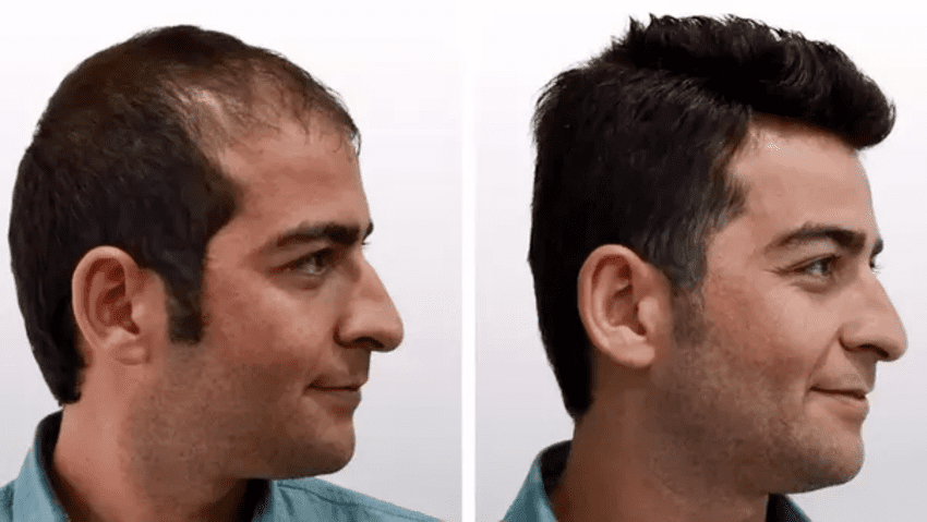 Photo avant et après une greffe de cheveux en Turquie