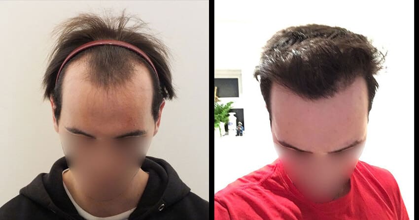 photo avant et apres d'une greffe de cheveux